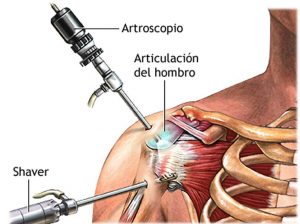 Lee más sobre el artículo Artroscopia de hombro