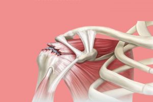 Lee más sobre el artículo Manguito Rotador: Anatomía, Lesión y Tratamiento