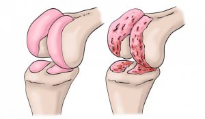 Lee más sobre el artículo Tratamientos quirúrgicos para artrosis de rodilla