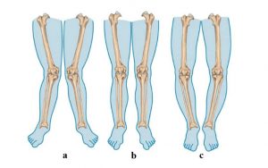 Lee más sobre el artículo Artrosis de rodilla