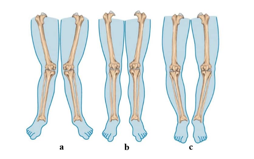 Artrosis de rodilla - Wikipedia, la enciclopedia libre